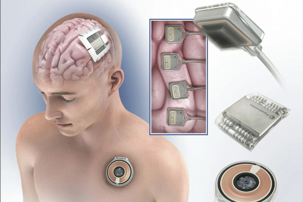 chip neural